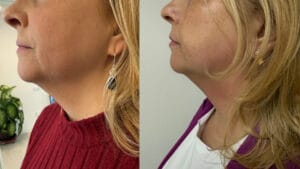 Rezultat before and after radiofrecventa faciala cu viora v10 v-st la Episculpt Beauty, imbunatatire textura si riduri.