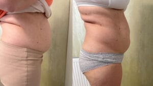 rezultat dupa o sedinta de criolipoliza sibiu