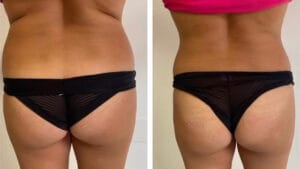 reducerea tesutului adipos si tonifierea musculaturii prin electrostimulare musculara, rezultat dupa 6 sedinte