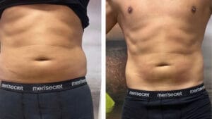 rezultat dupa 12 sedinte de electrostimulare musculara la Episculpt Beauty