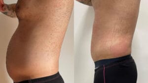 inainte si dupa electrostimulare cu wonder prestige