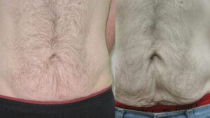 rezultat dupa 5 sedinte de tratament pentru reducerea laxitatii prin radiofrecventa corporala