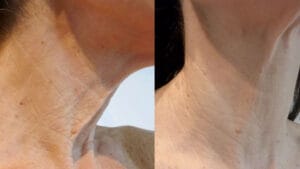 imbunatatire textura piele si riduri, zona gatului dupa 3 sedinte de radiofrecventa faciala