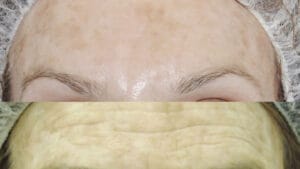 reducere riduri persoane in varsta dupa lifting prin radiofrecventa faciala