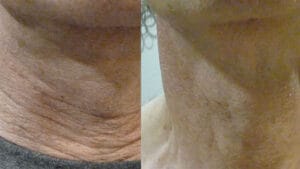 Rezultat before and after lifting piele gat prin radiofrecventa faciala