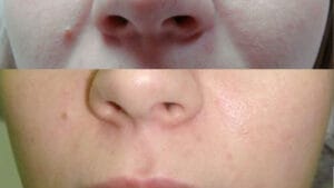 imbunatatire riduri si textura piele dupa radiofrecventa faciala