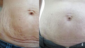 reducere vergeturi prin radiofrecventa la Episculpt Beauty