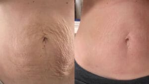 rejuvenarea pielii prin radiofrecventa la Episculpt Beauty, imbunatatirea texturii, reducerea vergeturilor si cicatricilor