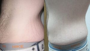 rejuvenare piele, reducere vergeturi prin radiofrecventa la Episculpt Beauty