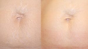 reducerea cicatricilor dupa procedura de rejuvenare piele prin radiofrecventa