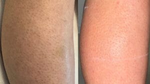 rezultat dupa 2 sedinte de epilare definitiva cu laser la Episculpt Beauty