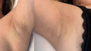 rezultat dupa 2 sedinte de epilare definitva laser in zona axilelor