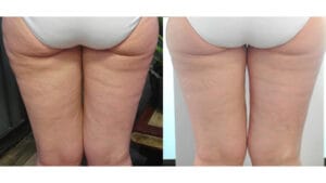 rezultat dupa 3 sedinte de radiofrecventa corporala cu viora v10 v-form