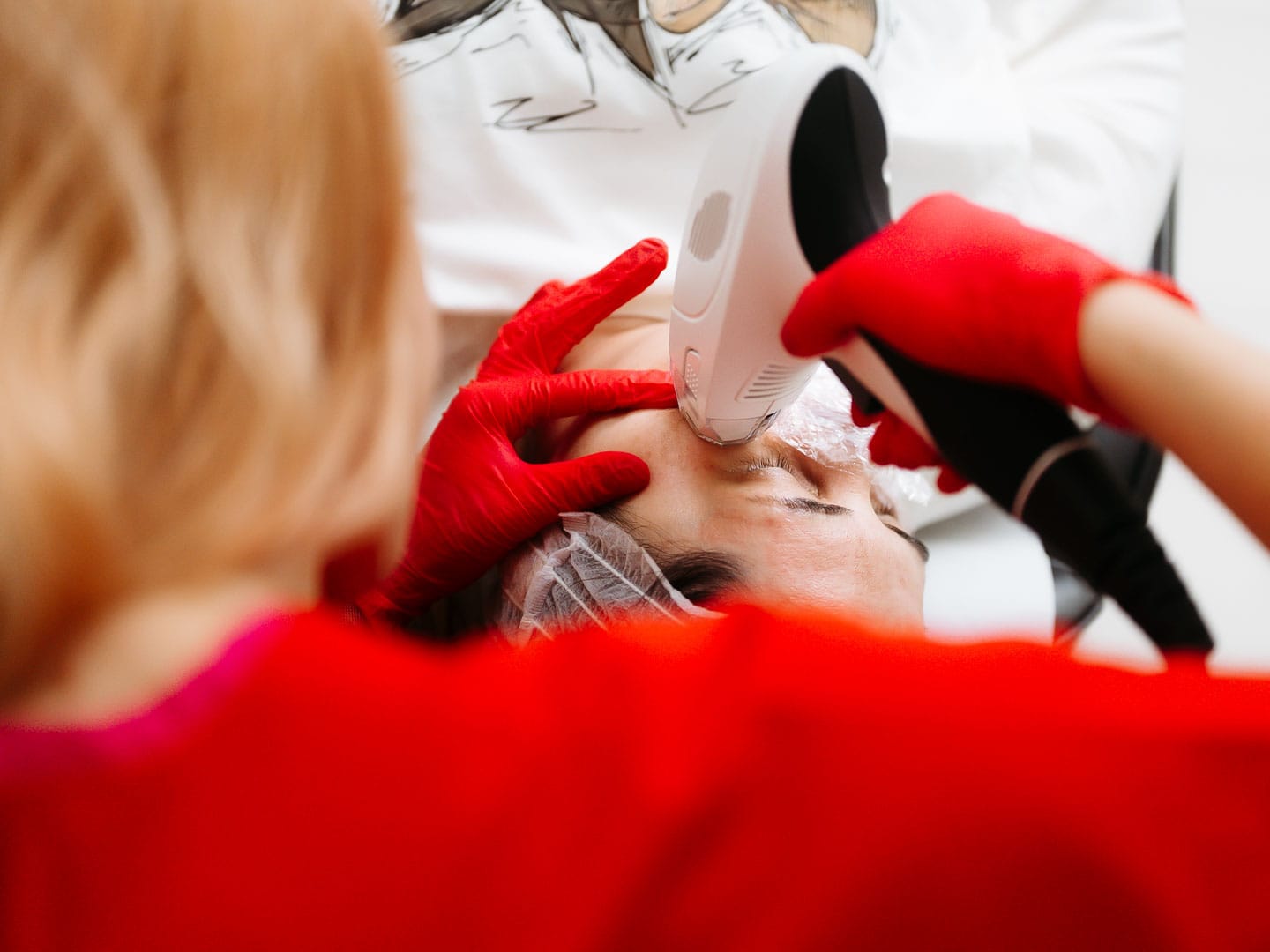 rejuvenare faciala prin radiofrecventa fractionata cu viora v10 v-fr