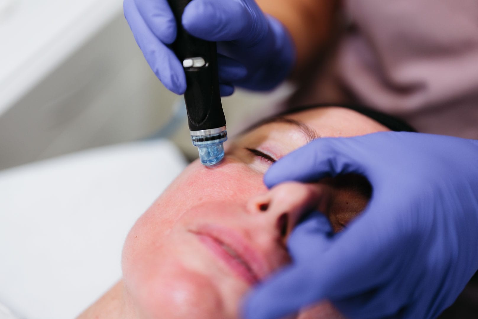 curatarea tenului cu hydrafacial la episculpt beauty