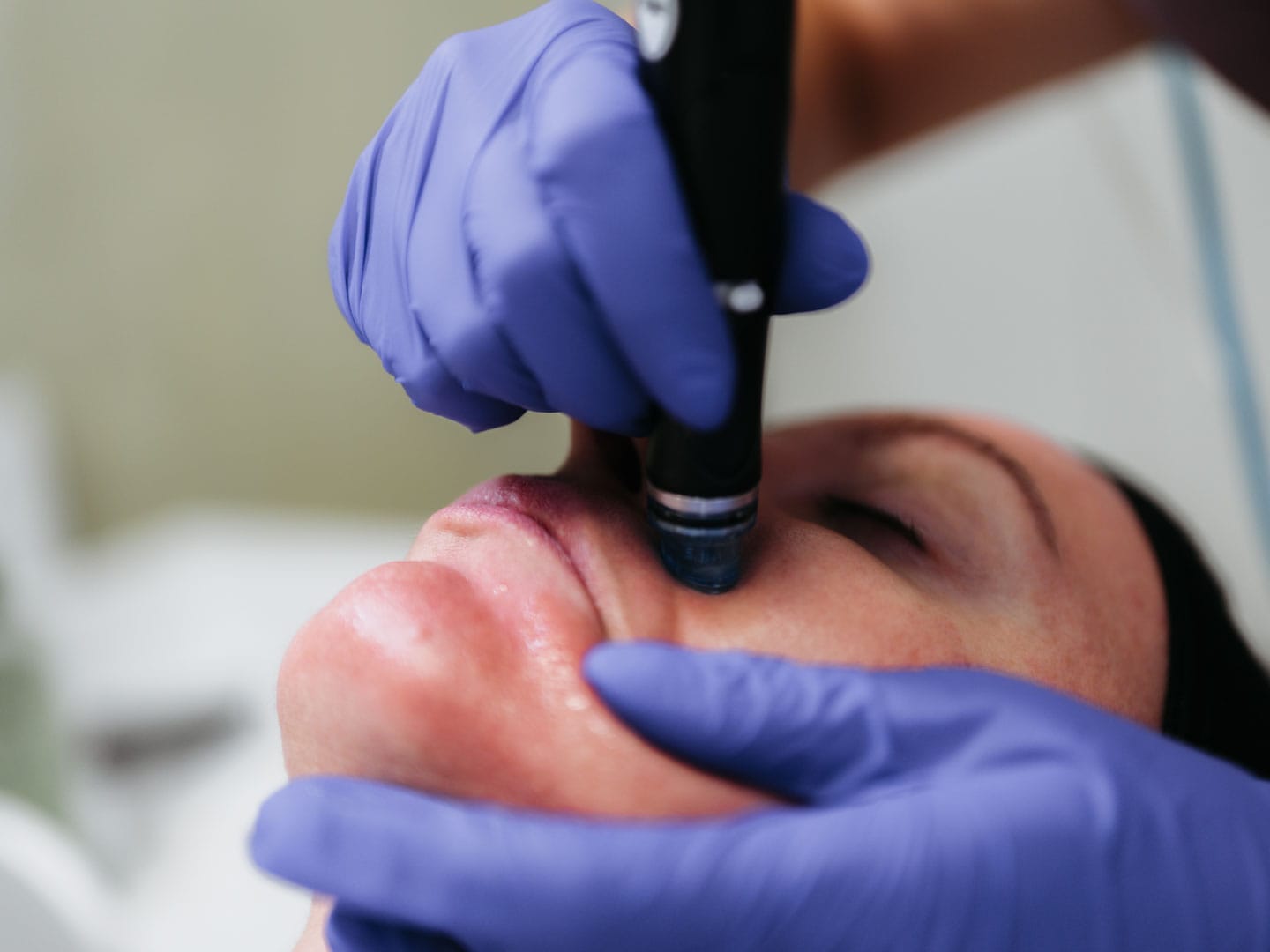 in timpul unui tratament hydrafacial la episculpt beauty sibiu