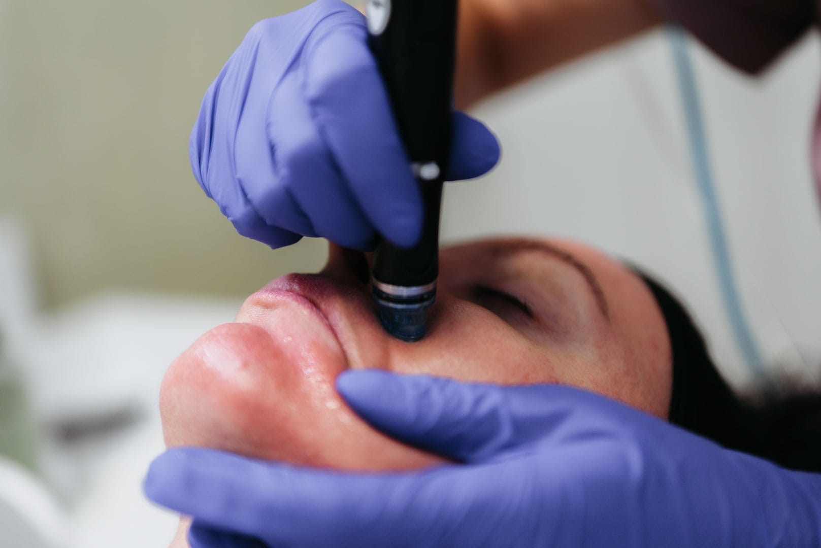 tratament hydrafacial sibiu la episculpt beauty