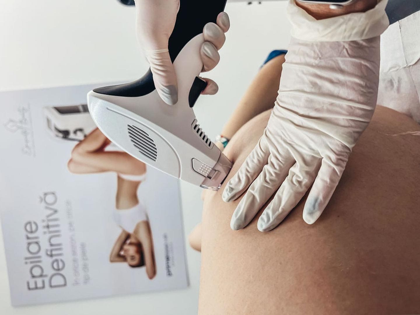 tratament vergeturi in sibiu prin radiofrecventa fractionata